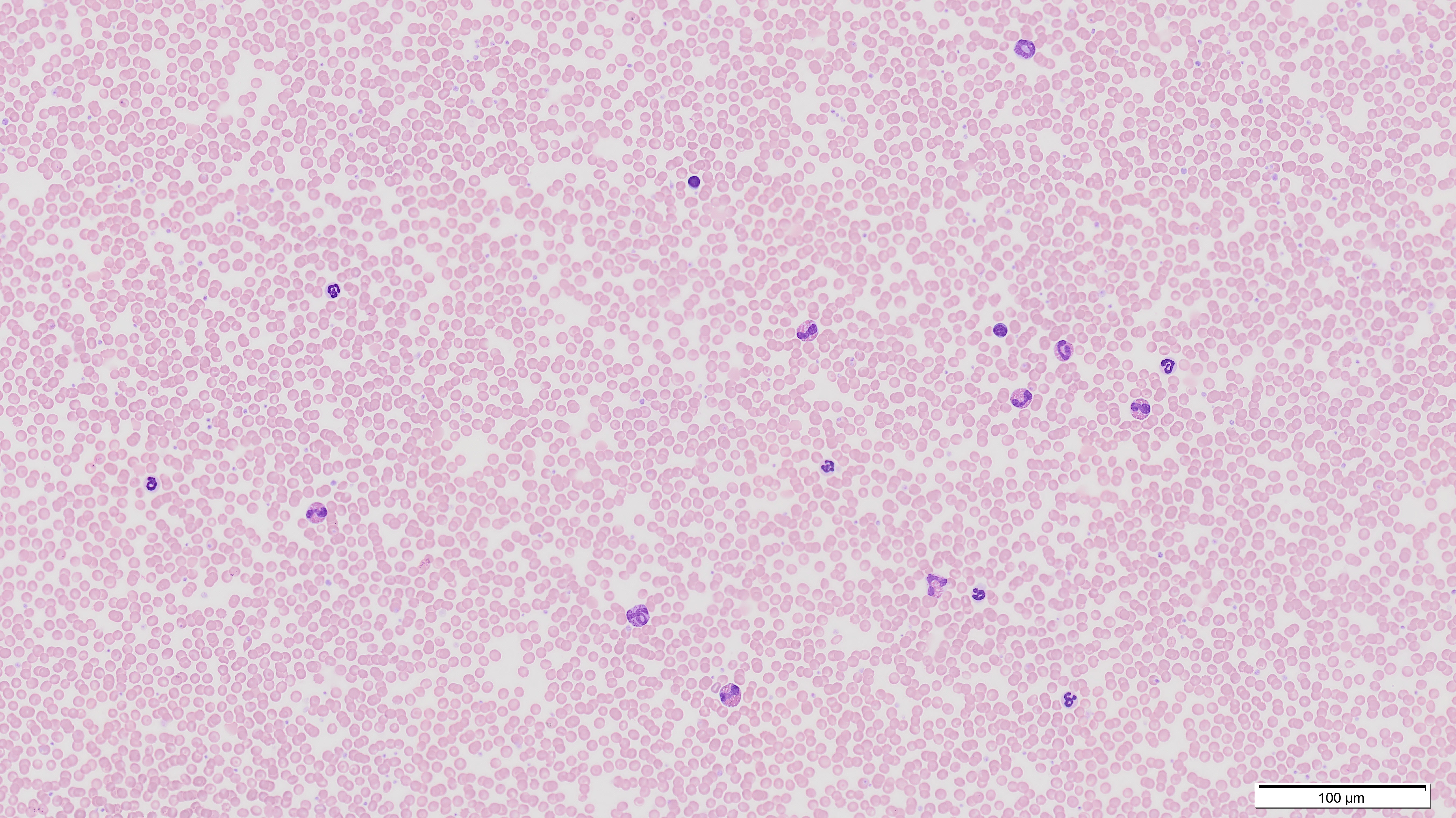 Eosinophilie